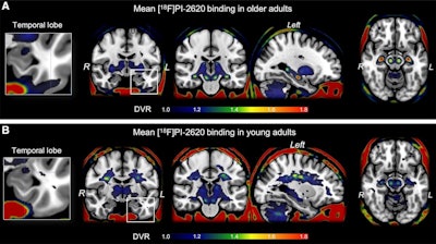 Tau PET tracer flags early Alzheimer risk in healthy older adults