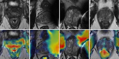 AI framework could improve MRI quality control in prostate cancer