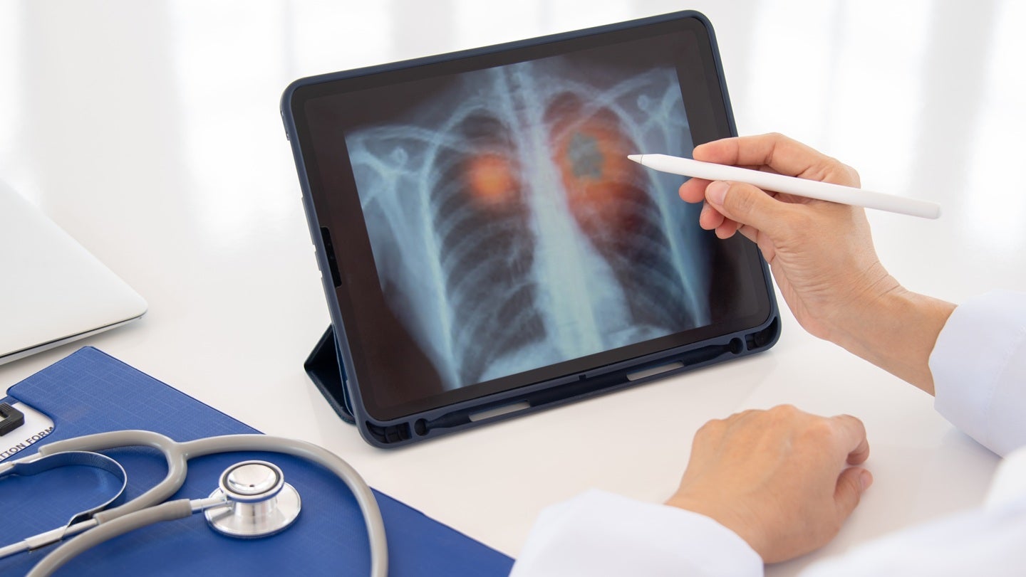 Optellum and Coreline Soft plan AI integration for lung nodule care