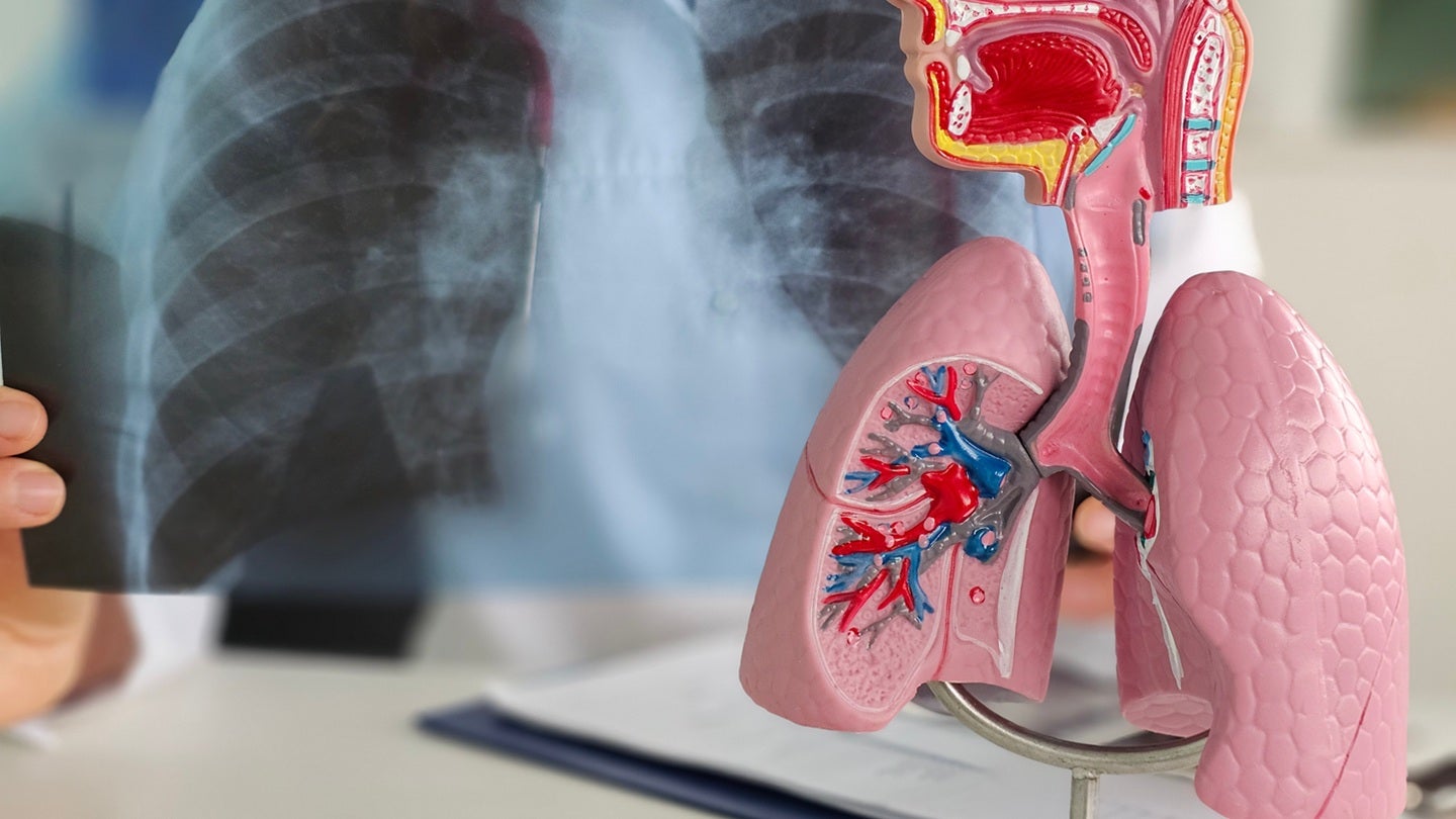 Freenome’s lung cancer test receives FDA breakthrough status