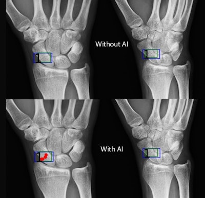 AI fracture detection device validated across three European hospitals