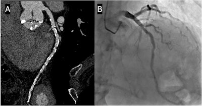 Is nitroglycerin necessary prior to photon-counting CT?