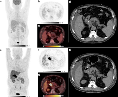 FAPI-PET/CT shows promise in hepatopancreatobiliary cancers