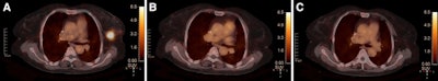 PET/CT predicts response to neoadjuvant therapy in breast cancer