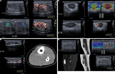 Advanced ultrasound techniques improve soft tissue tumor evaluation