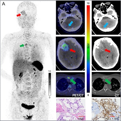 New immuno-PET tracer shows promise in lung cancer
