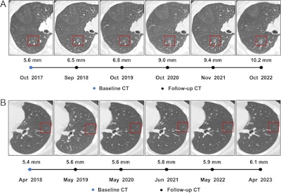 CT reveals progressive growth pattern in incidental lung nodules