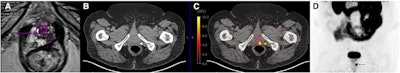 PET/CT outperforms MRI after focal therapy for prostate cancer