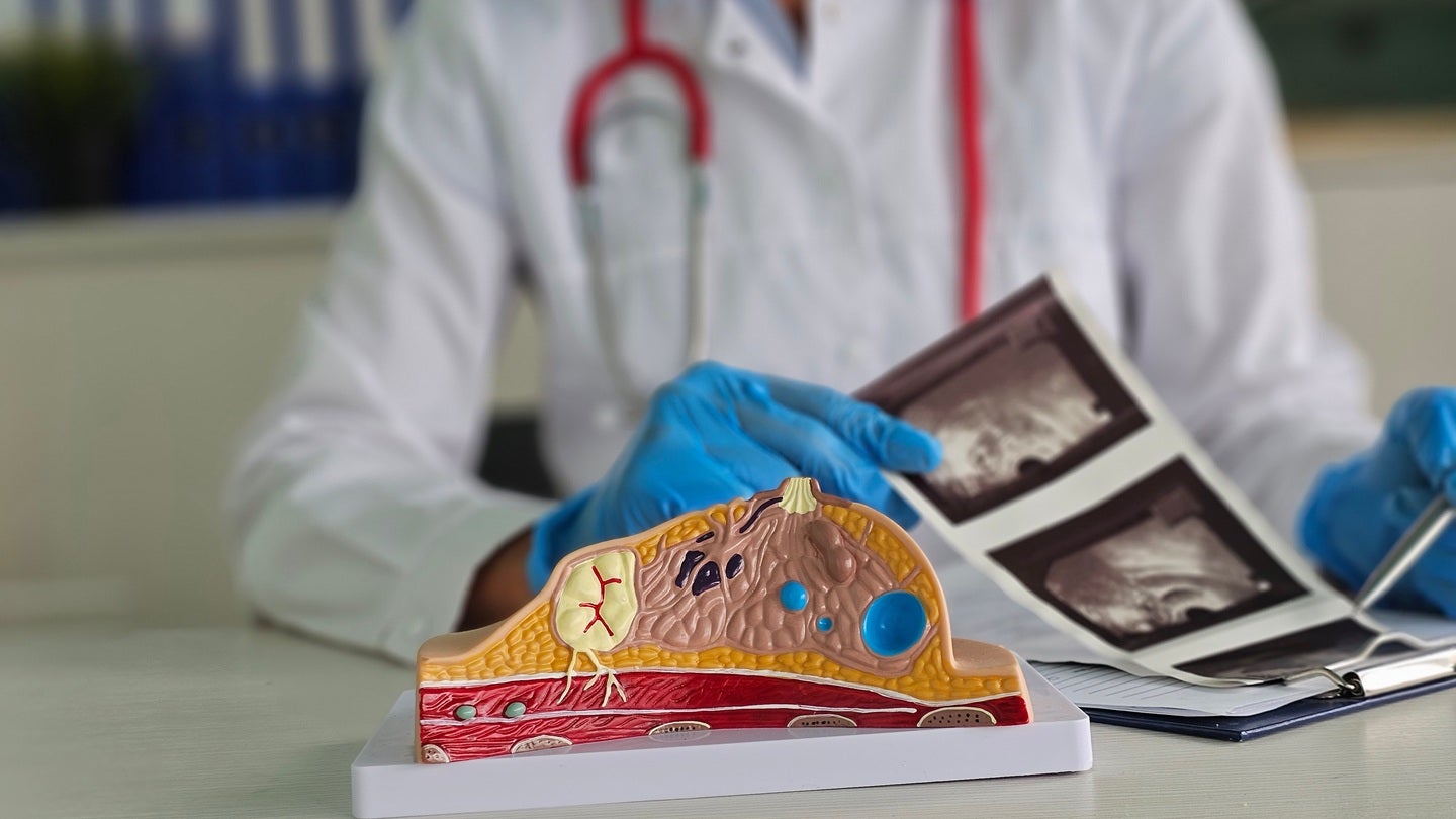 FDA approves AstraZeneca’s Etcamah combo for advanced breast cancer