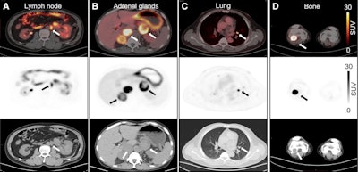 CAIX-targeted PET tracer shows promise in patients with ccRCC