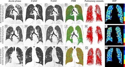 What are the effects of COVID-19 pneumonia after 5 years?