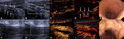 Super-resolution CEUS shows promise in Crohn’s disease assessment