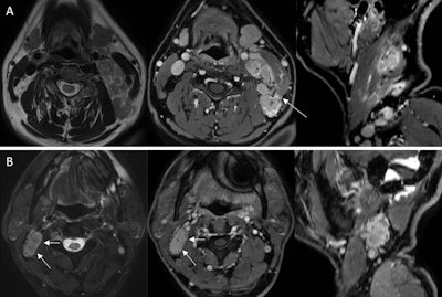 Image-based grading system estimates nasopharyngeal carcinoma severity