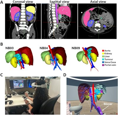 VR boosts accuracy, confidence for evaluating abdominal neuroblastoma