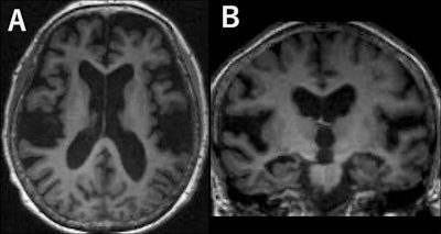 Brain MRI features linked to cognitive decline in older populations