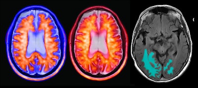 Positive Amyloid PET study alongside an AI-based quantitative MRI for ARIA surveillance