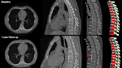 LDCT predicts vertebral fracture risk in heavy smokers
