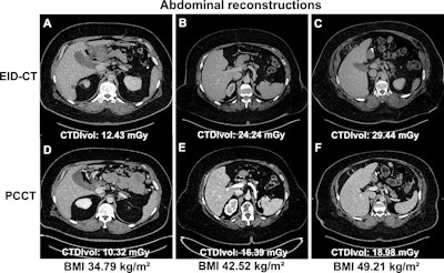 PCCT improves image quality when scanning patients with obesity