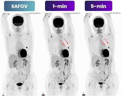 EANM: Next-generation PET scanner cuts imaging time to one minute