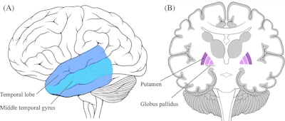 MRI, PET reveal distinct brain changes in loneliness and social isolation