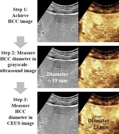 New ultrasound feature predicts poor prognosis in HCC