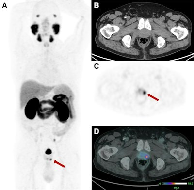 SNMMI: PSMA-PET/CT-guided biopsy improves prostate cancer detection